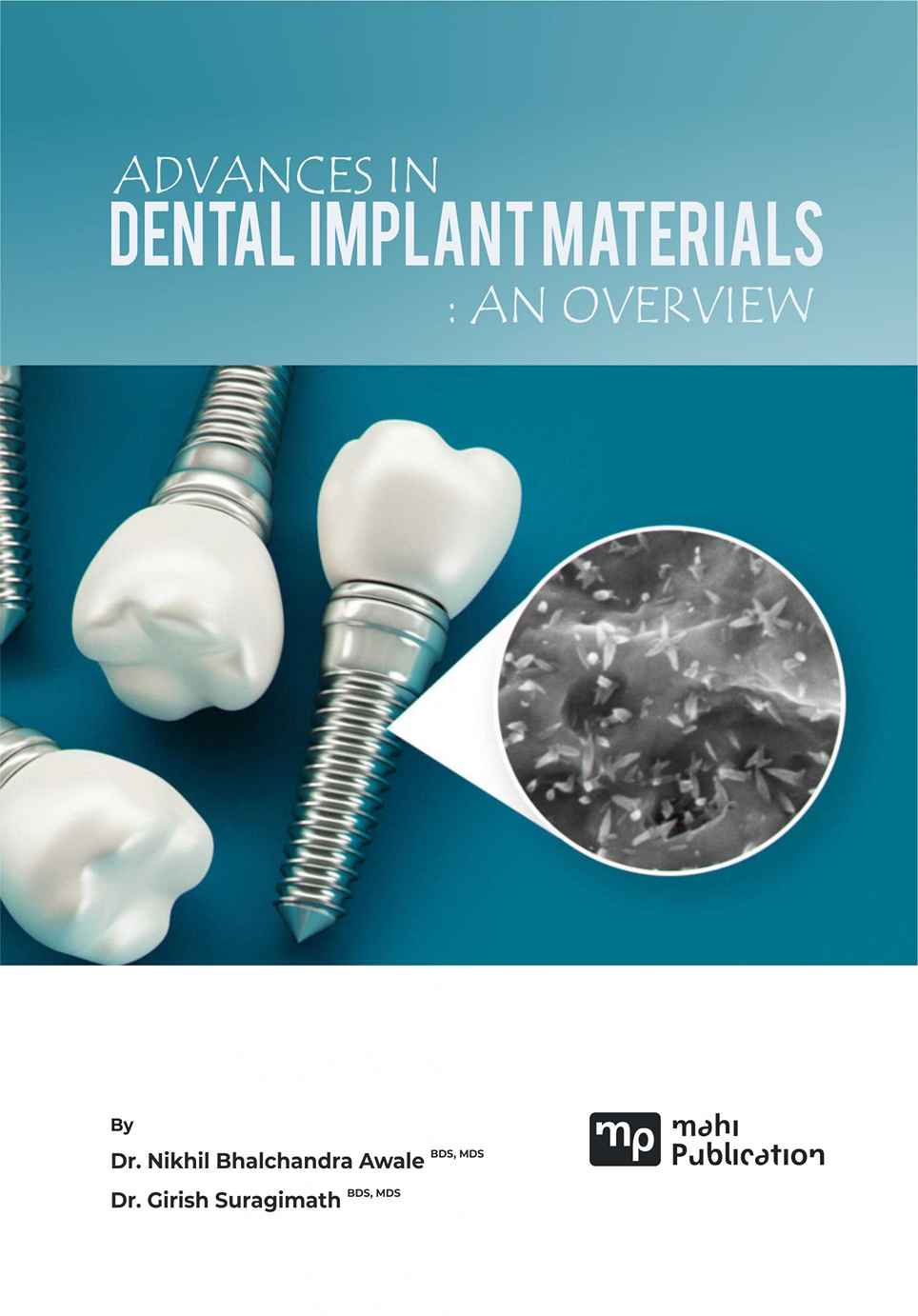Advances in Dental Implant Materials an Overview