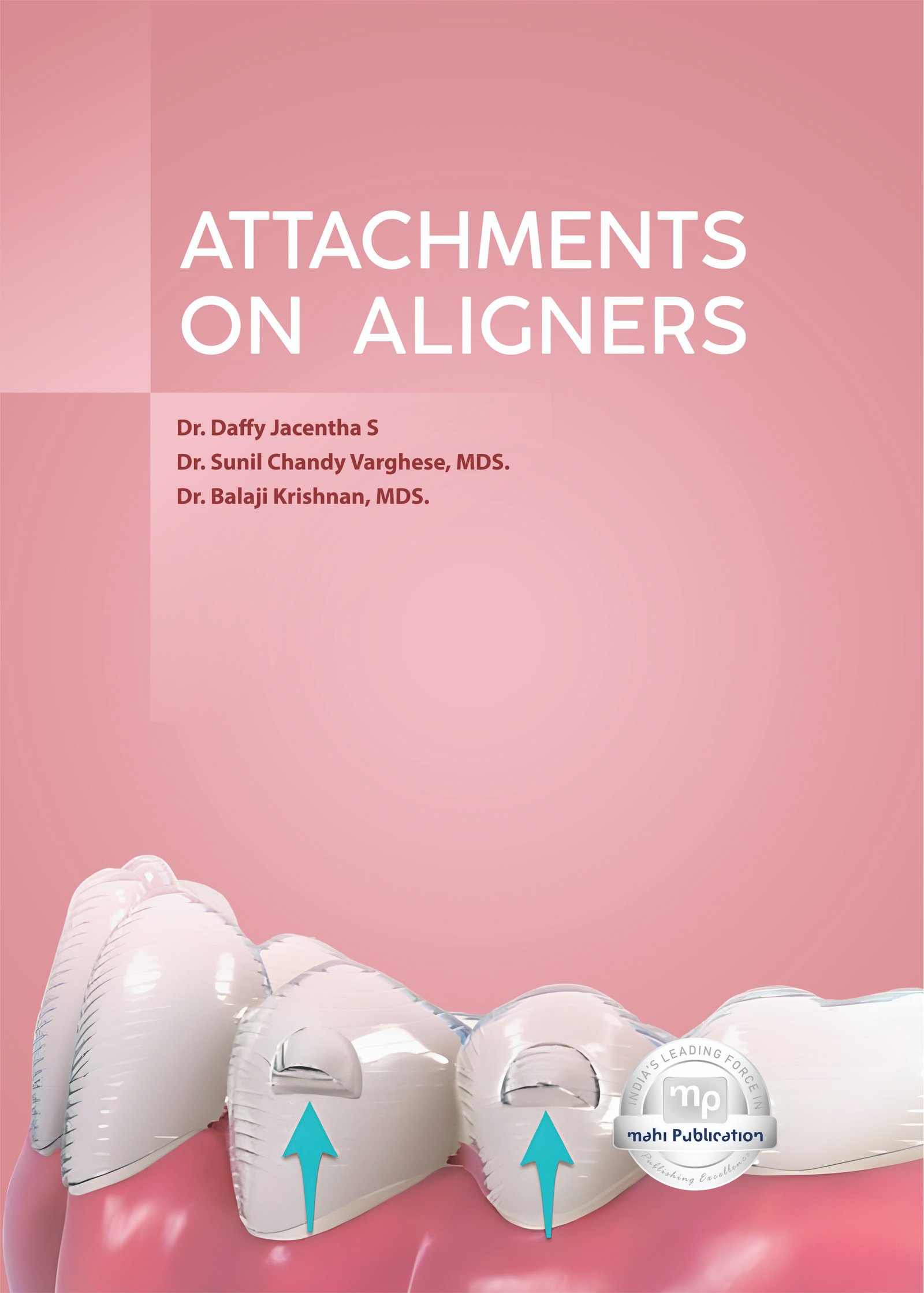 Attachments On Aligners