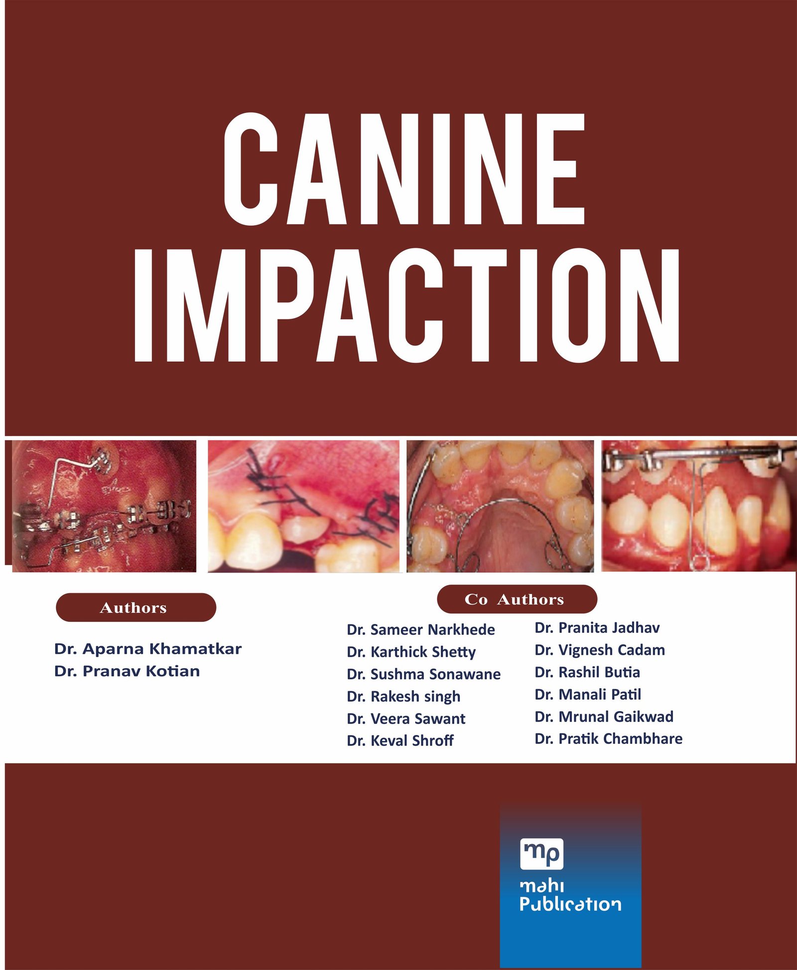 Canine Impaction