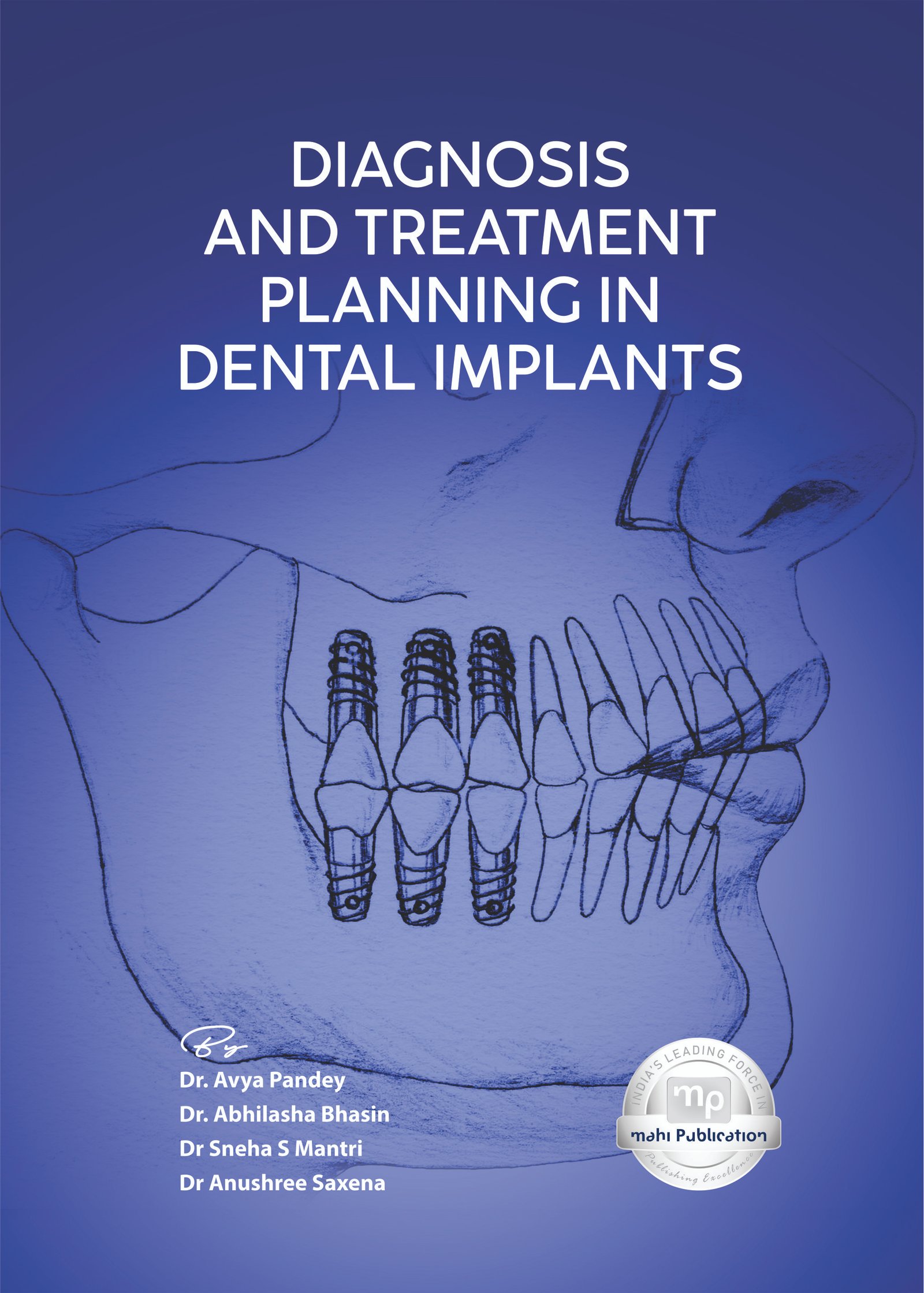 Diagnosis and Treatment Planning in Dental Implants