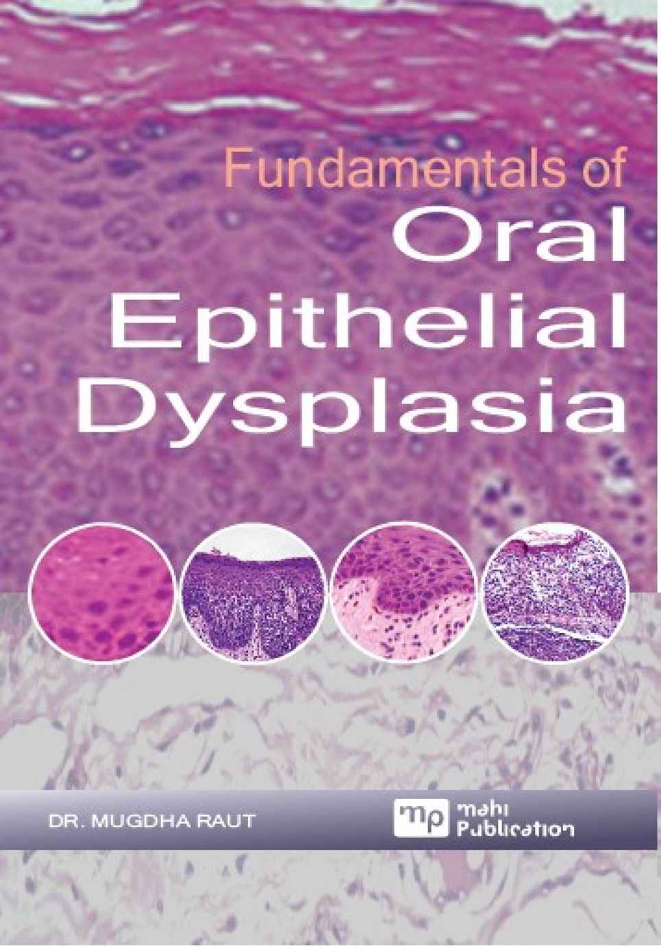Fundamentals Of Oral Epithelial Dysplasia