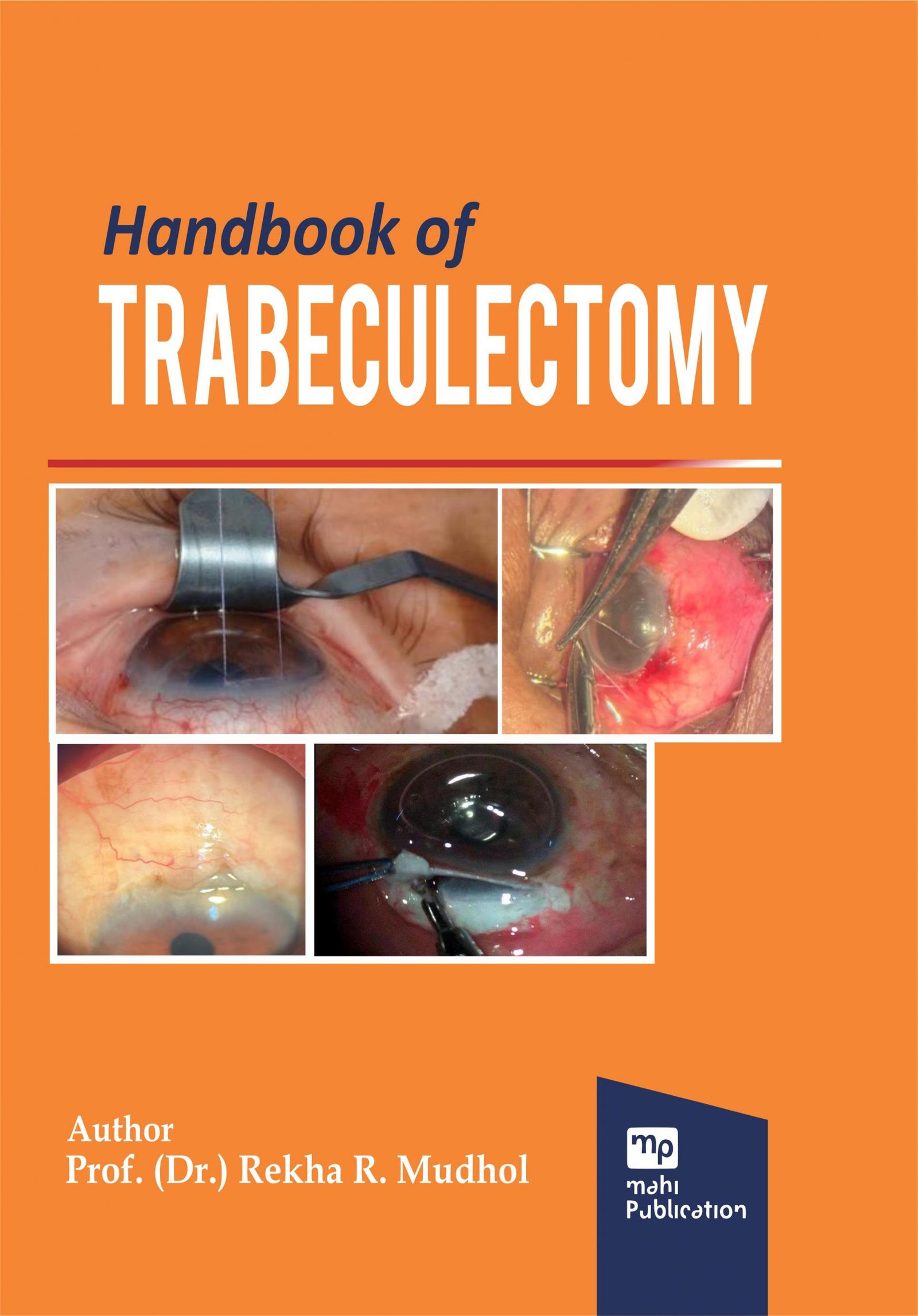 Handbook of Trabeculectomy