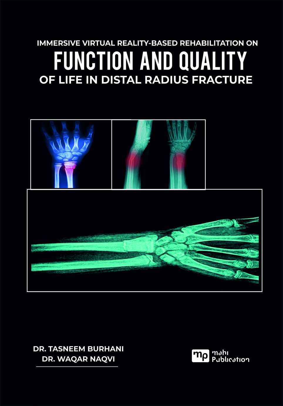 Immersive Virtual Reality-based Rehabilitation on Function and Quality of Life in Distal Radius Fracture