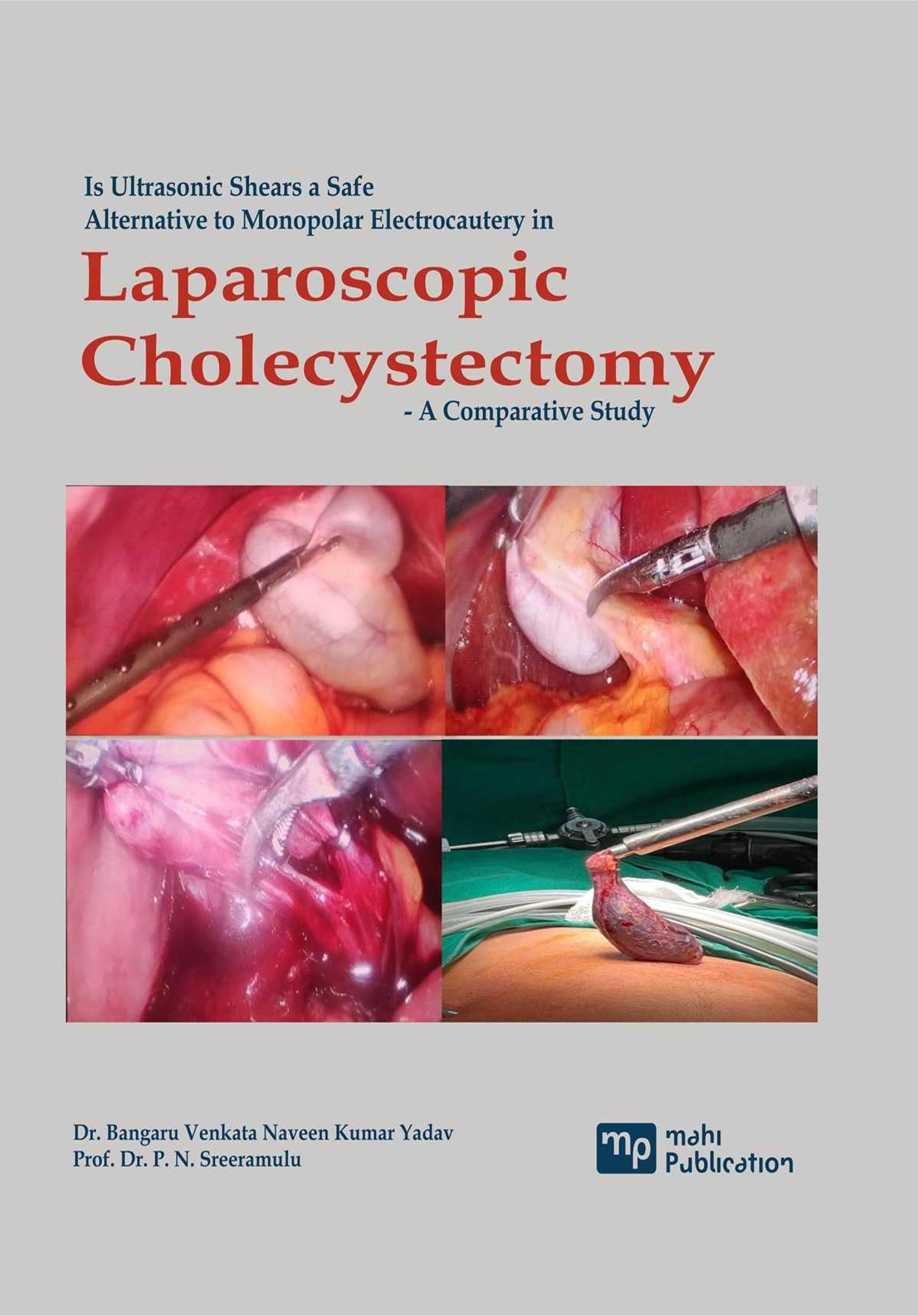 Is Ultrasonic Shears A Safe Alternative To Monopolar Electrocautery In Laparoscopic Cholecystectomy - A Comparative Study