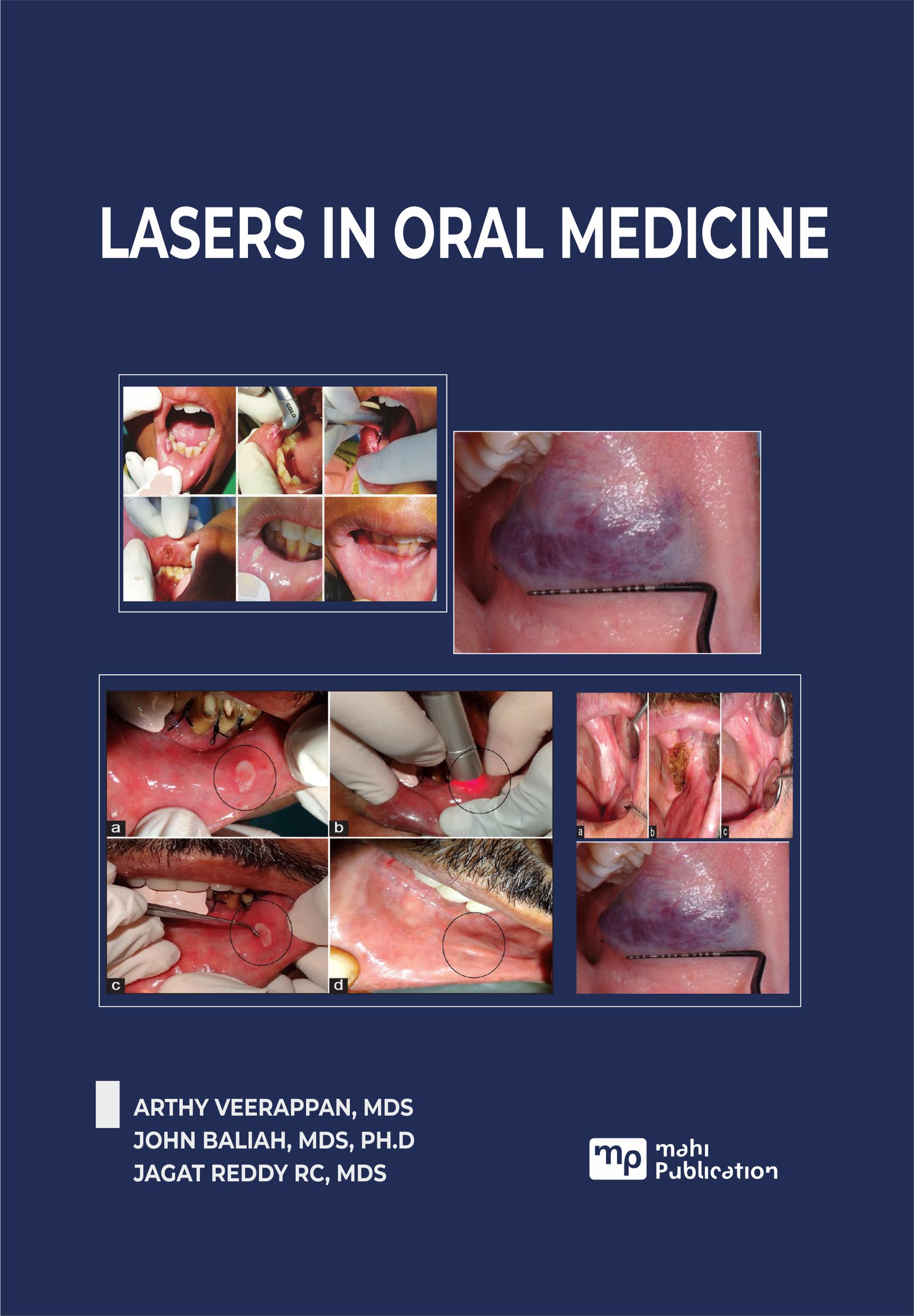 Lasers In Oral Medicine