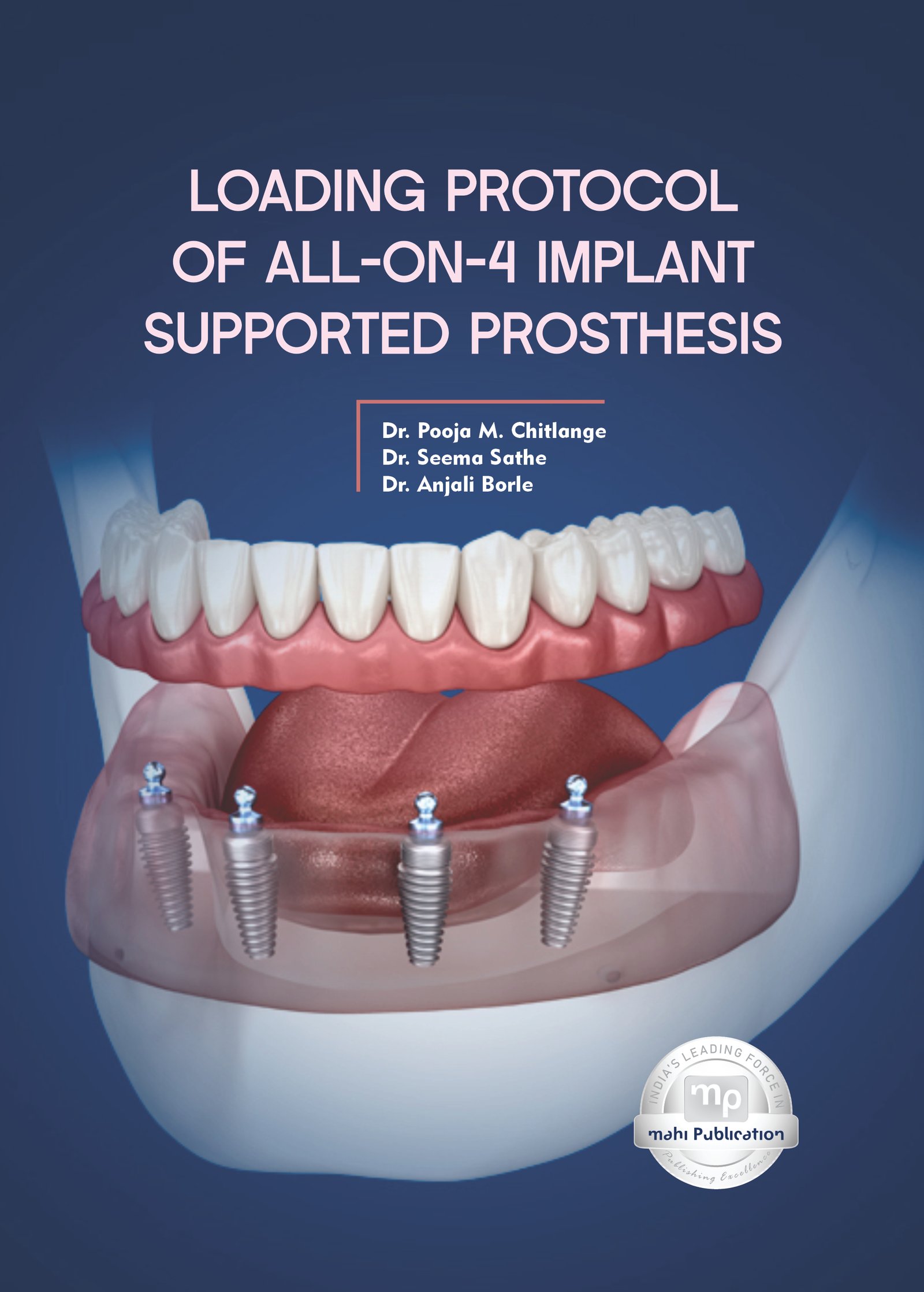  Loading Protocol of All-on-4 Implant-Supported Prosthesis