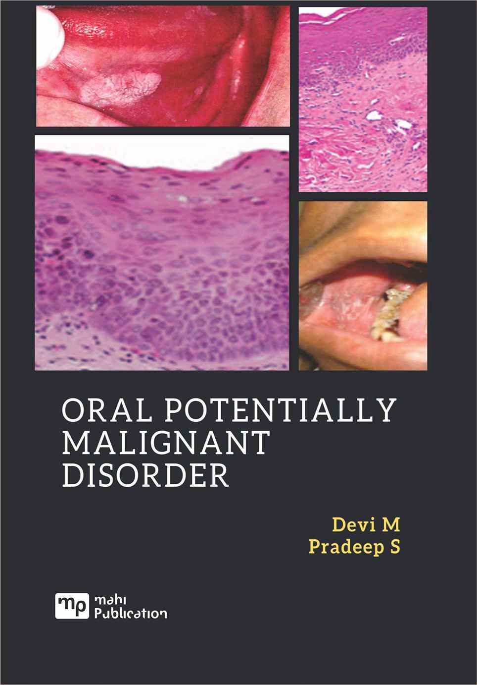 Oral Potentially Malignant Disorder
