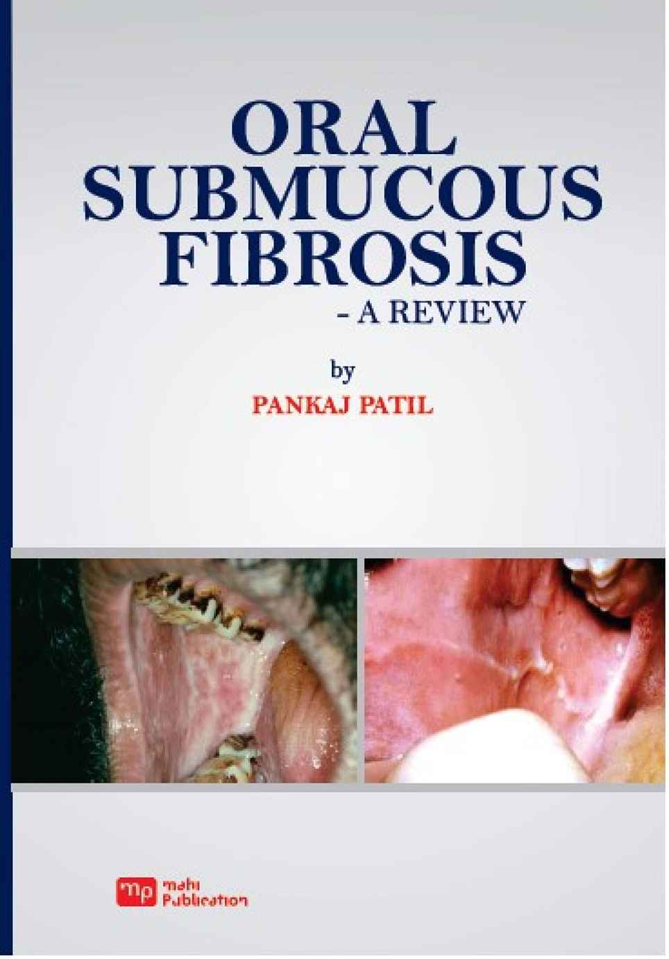 Oral Submucous Fibrosis - A Review