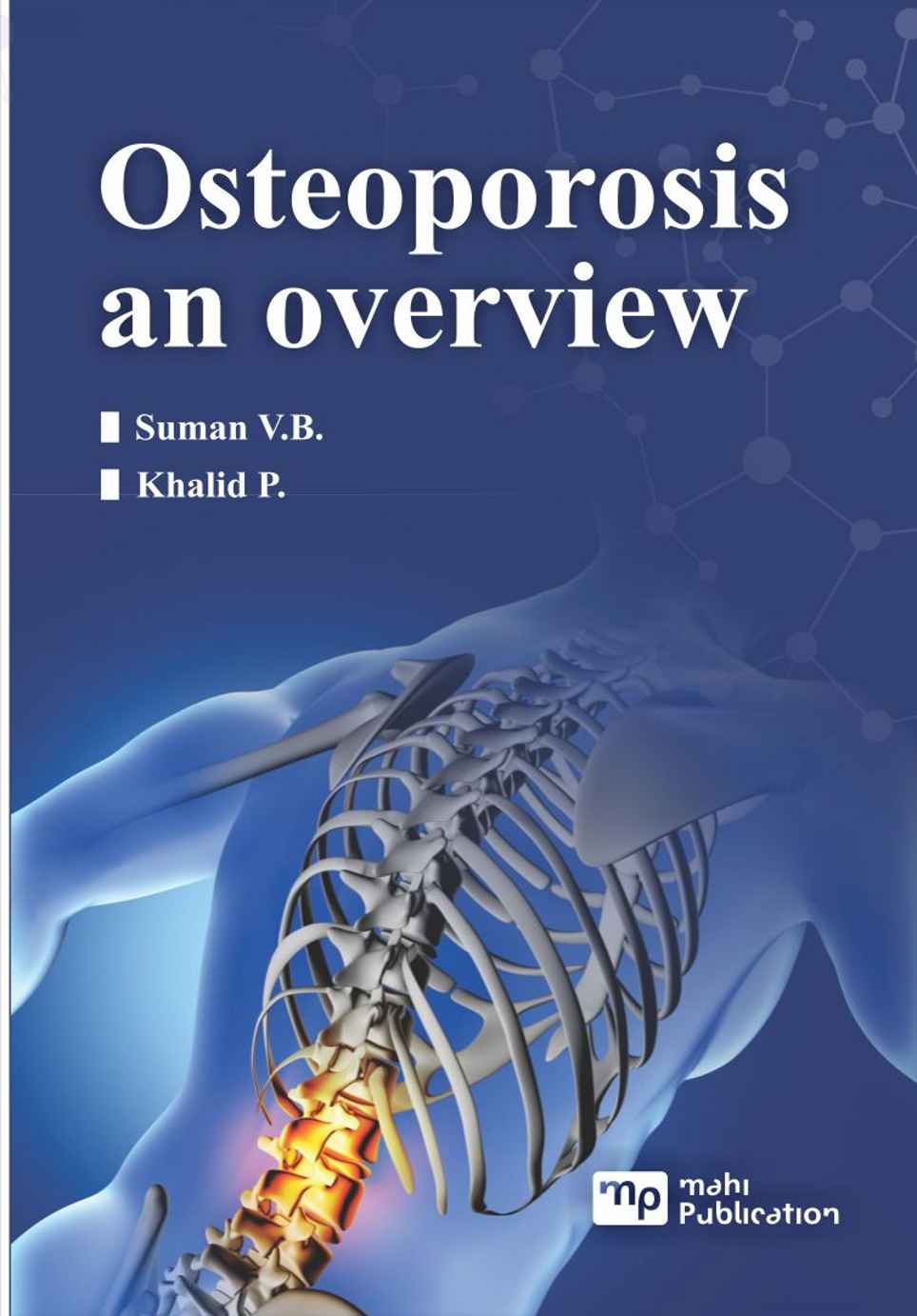 Osteoporosis an Overview