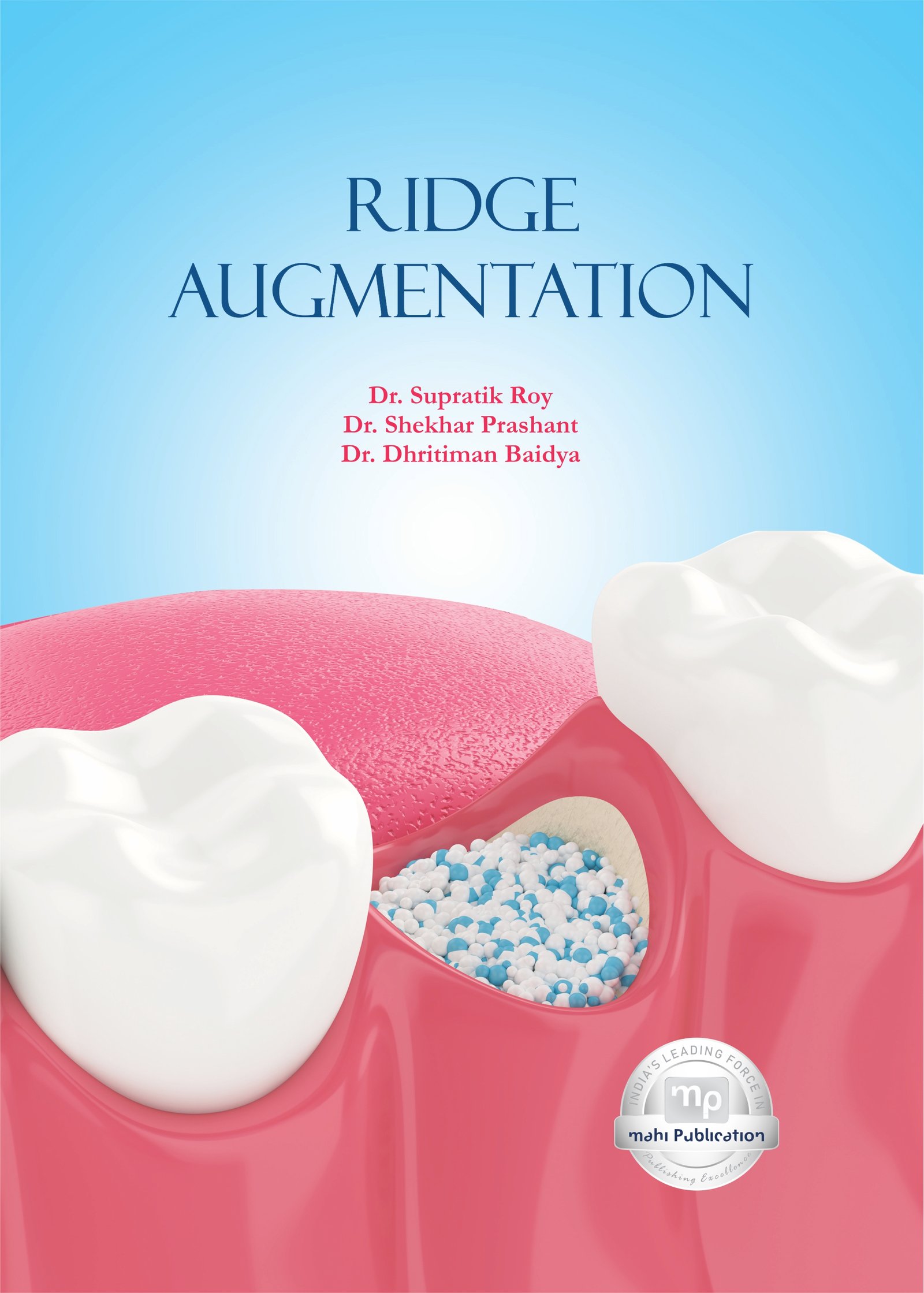 Ridge Augmentation