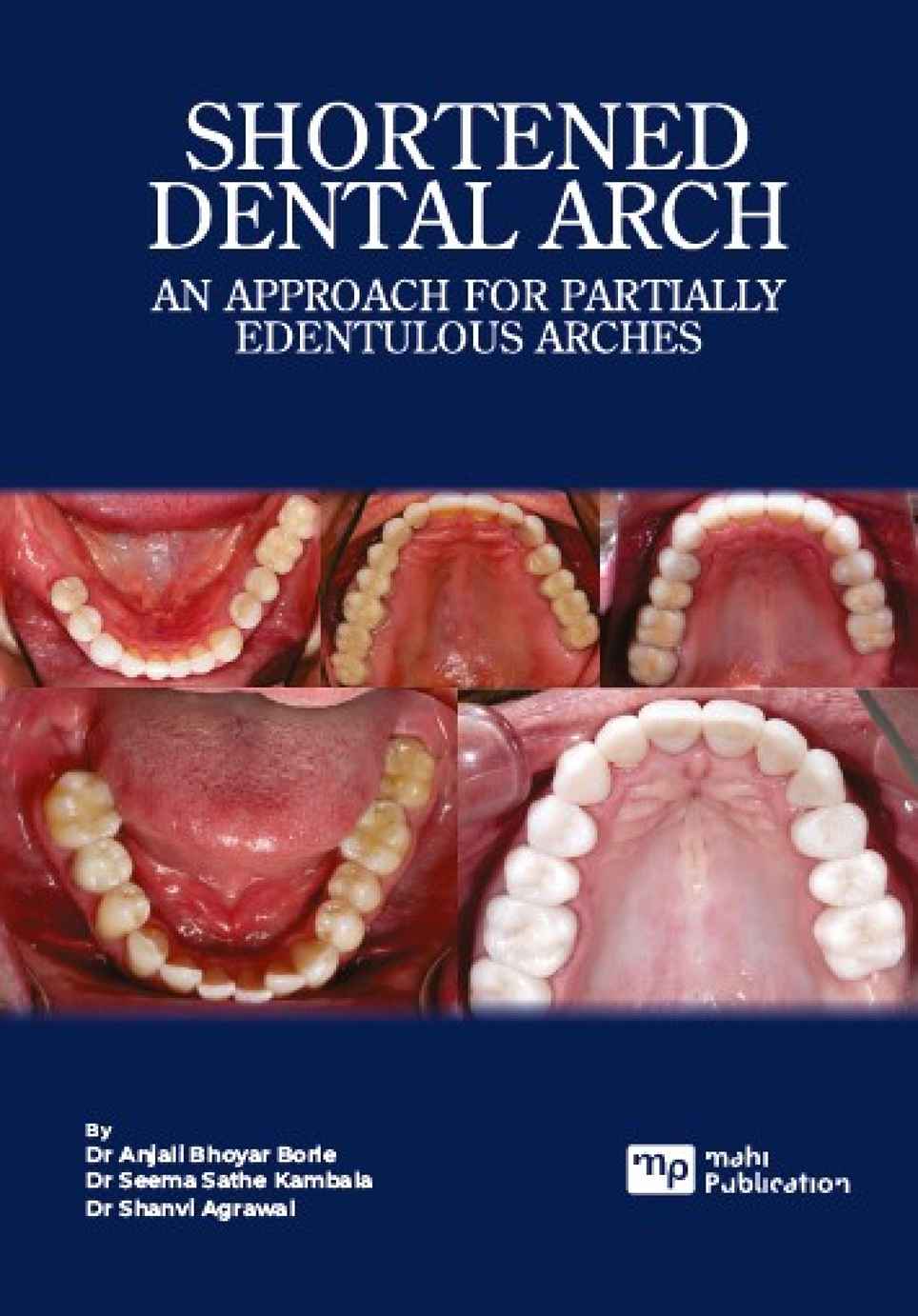 Shortened Dental Arch an Approach for Partially Edentulous Arches