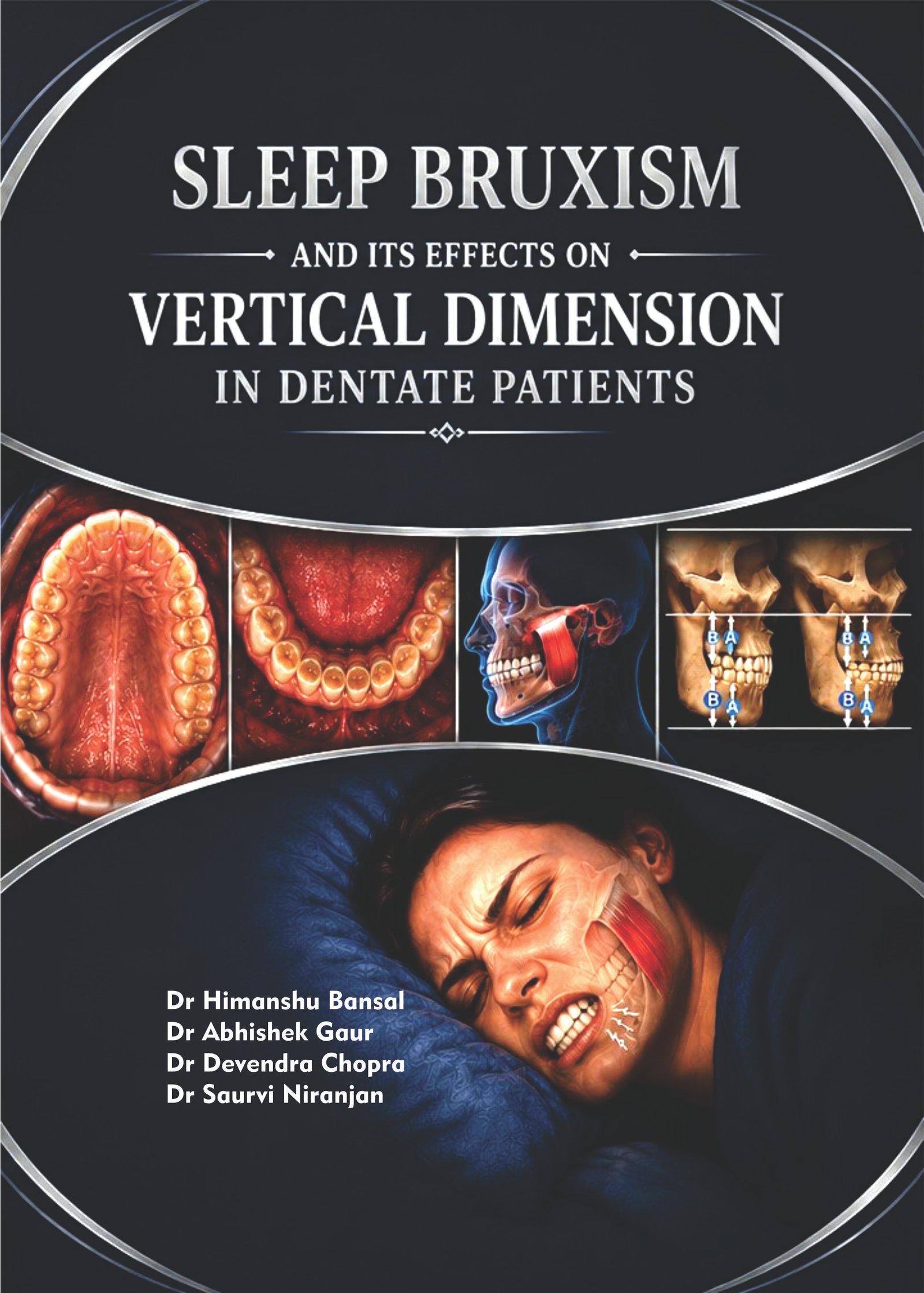 Sleep Bruxism and its effects on Vertical Dimension in Dentate Patients