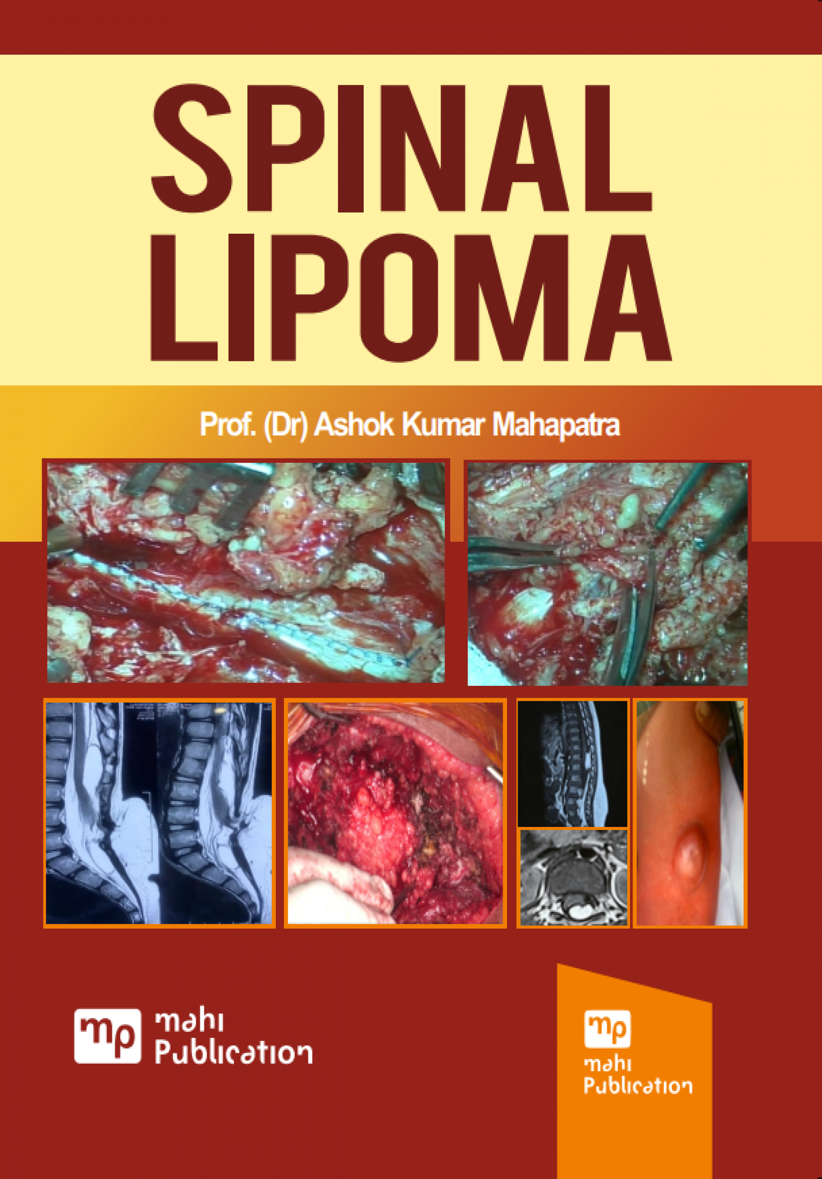 Spinal Lipoma