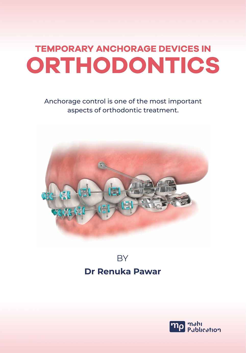 Temporary Anchorage Devices In Orthodontics